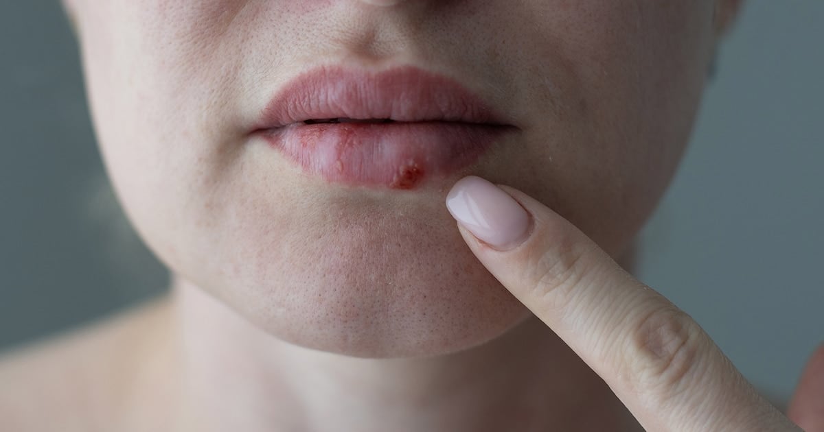 Después de casi 30 años, un antiviral oral nuevo para el herpes que se había vuelto resistente a todo