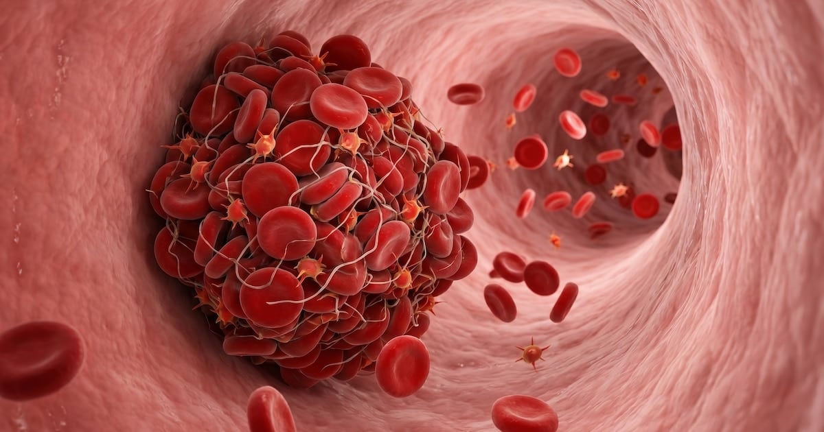 Trombosis venosa: las cuatro pistas del cuerpo que no conviene pasar por alto