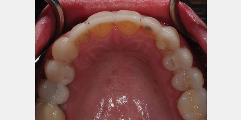 Carillas dentales: las señales de alerta que aparecen cuando el sellado empieza a fallar